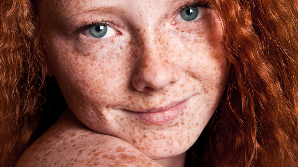 Can Skincare Get Rid Of Freckles?